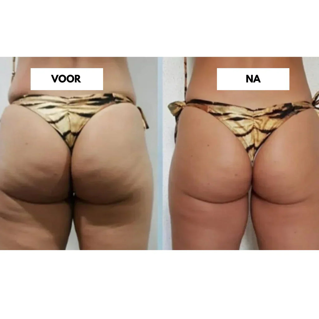 VelaTone | Vacuum Massager to Firm Skin and Reduce the Appearance of Cellulite