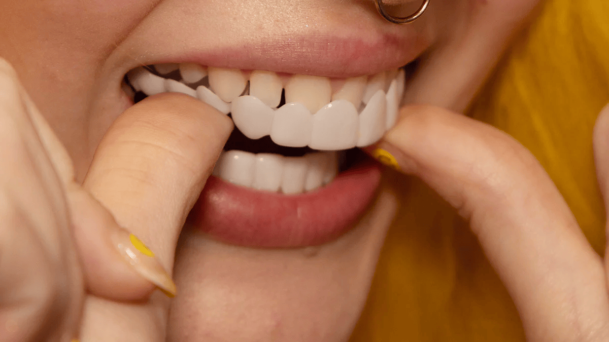 Evara | Removable Veneers for Upper & Lower