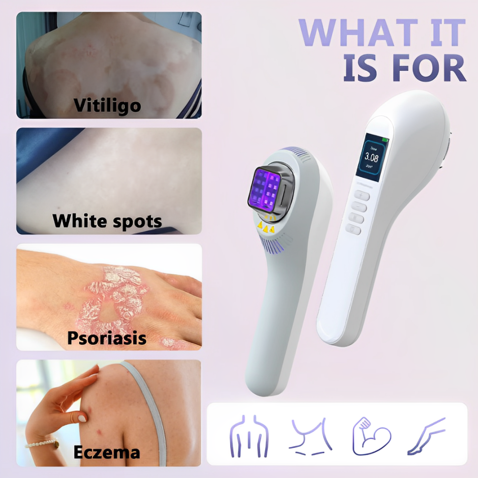 308 nm UVB Phototherapy Light for Vitiligo and Psoriasis
