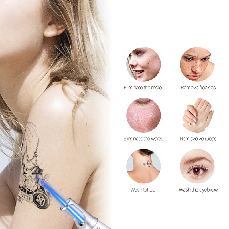 LumaDerm Smart Laser Pen for Fading Tattoos, Moles, Freckles & Acne