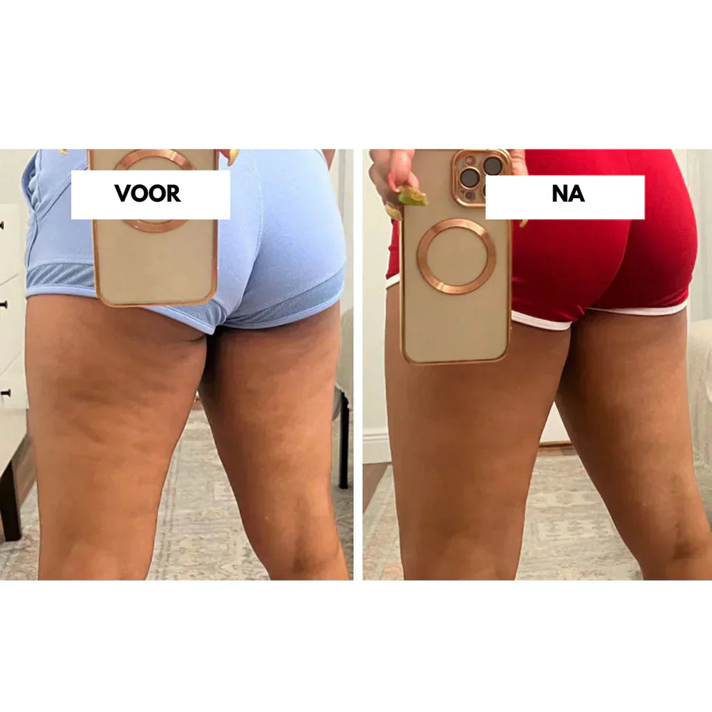 VelaTone | Vacuum Massager to Firm Skin and Reduce the Appearance of Cellulite