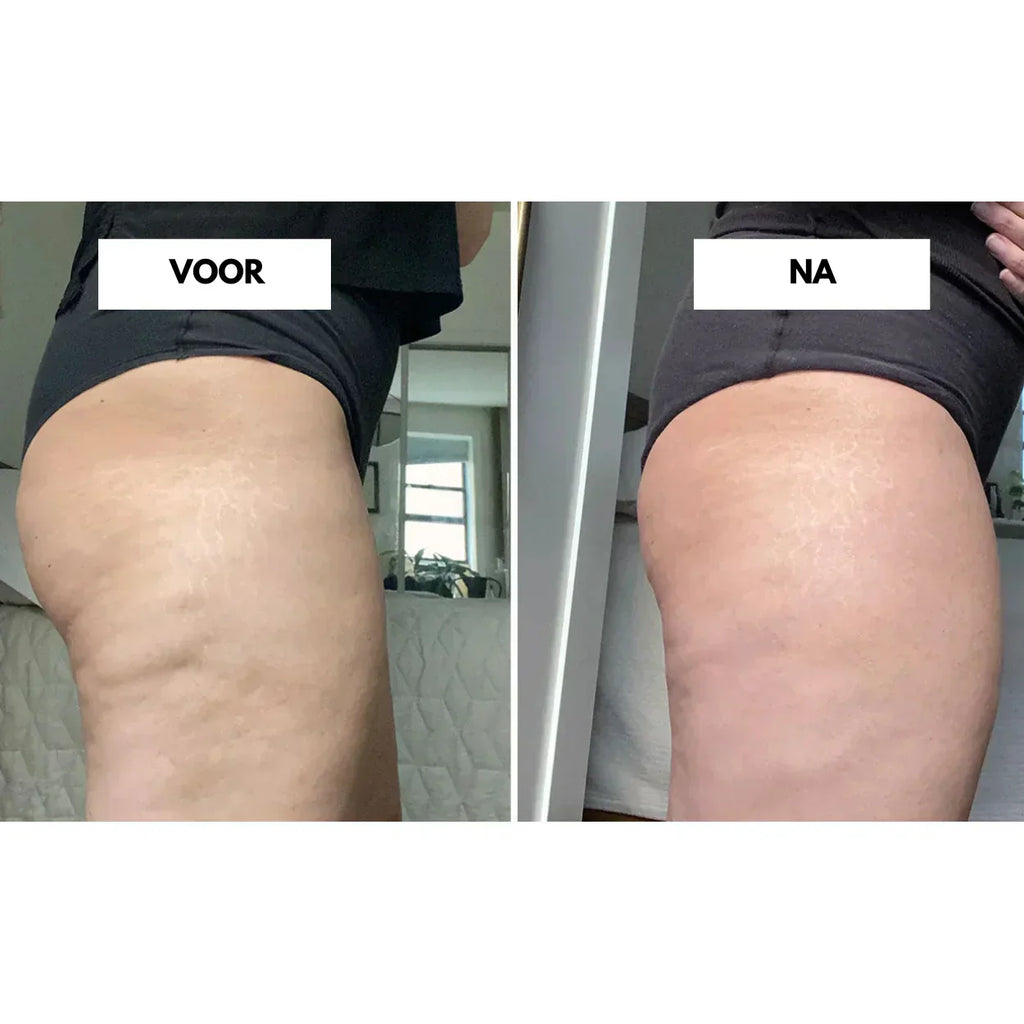 VelaTone | Vacuum Massager to Firm Skin and Reduce the Appearance of Cellulite