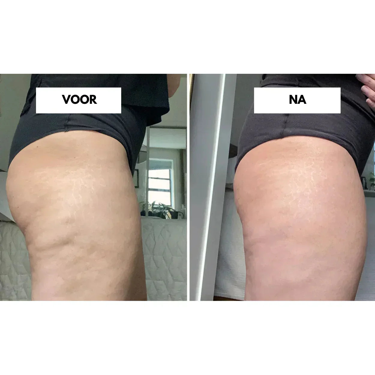 VelaTone | Vacuum Massager to Firm Skin and Reduce the Appearance of Cellulite