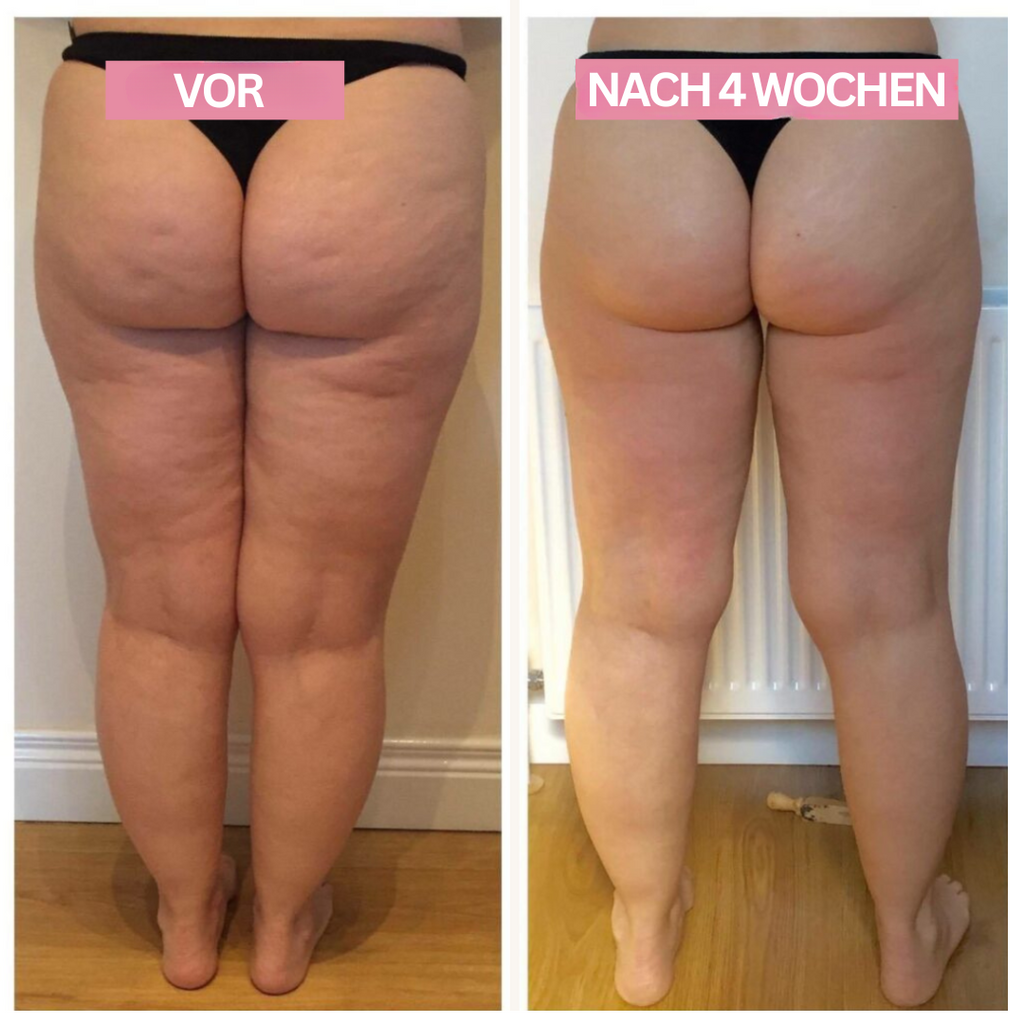 LumaSkin | Anti-Cellulite Cupping Device
