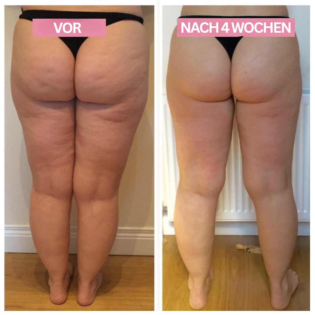 LumaSkin | Anti-Cellulite Cupping Device