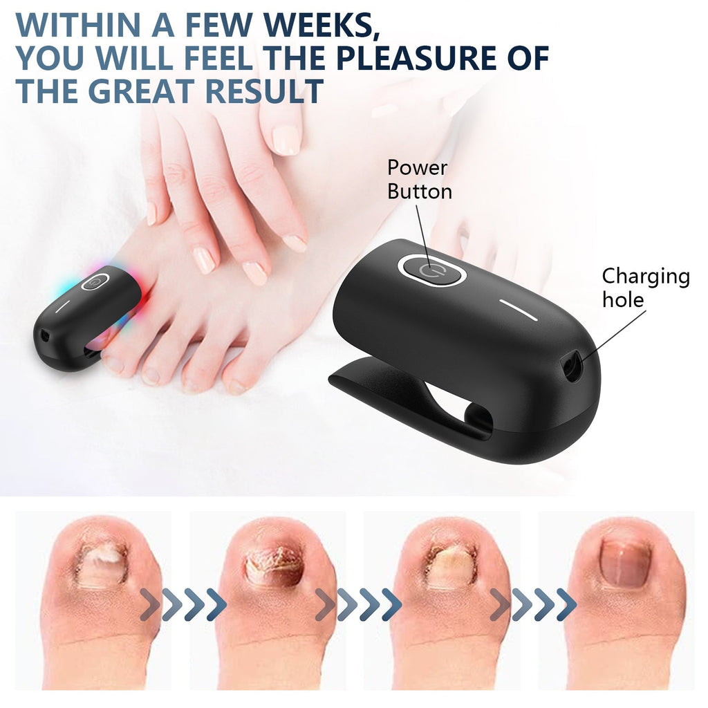 NailRevive | Laser Nail Fungus Care Device