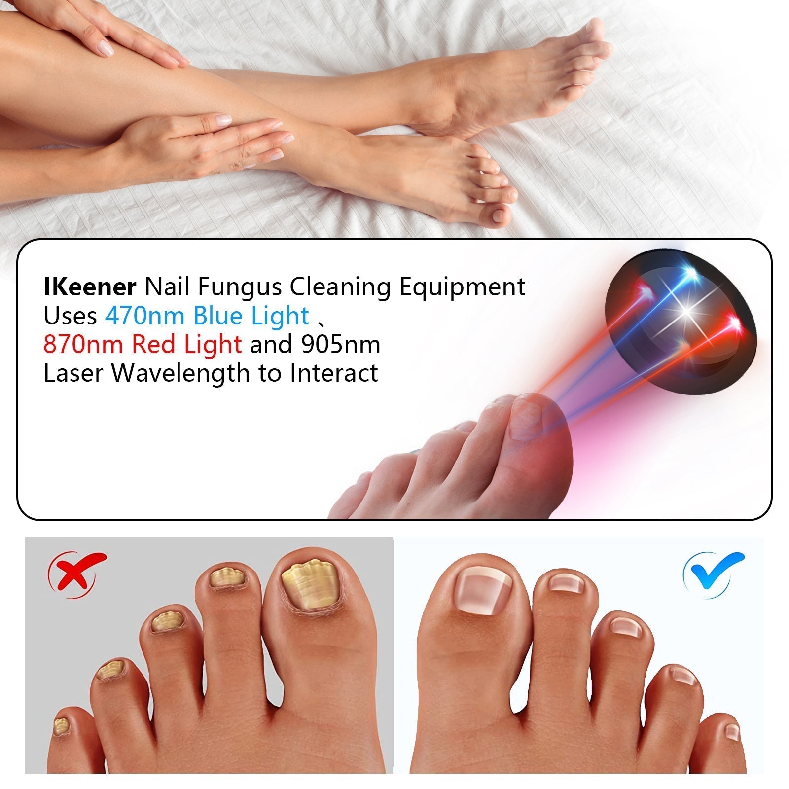 NailRevive | Laser Nail Fungus Care Device